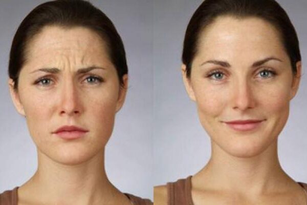 botox-party-marrackech