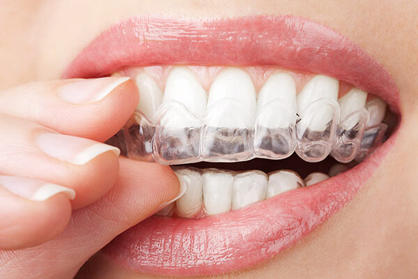 invisalign-1